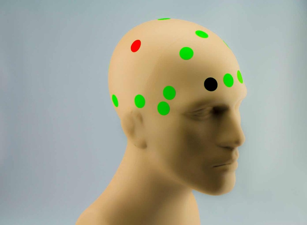TDCS electrode placement possibilities